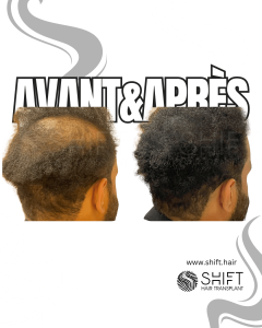 Avant Après de la micropigmentation du cuir chevelu pour le camouflage de densité en Turquie chez SHIFT Hair à Istanbul 31 3
