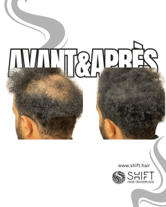 Avant Après de la micropigmentation du cuir chevelu pour le camouflage de densité en Turquie chez SHIFT Hair à Istanbul 32 3
