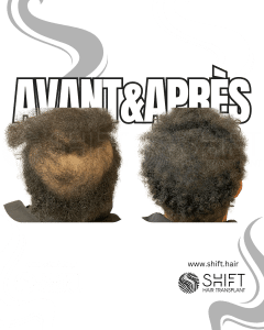 Avant Après de la micropigmentation du cuir chevelu pour le camouflage de densité en Turquie chez SHIFT Hair à Istanbul 33 3