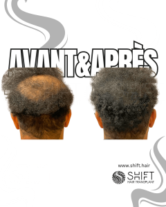 Avant Après de la micropigmentation du cuir chevelu pour le camouflage de densité en Turquie chez SHIFT Hair à Istanbul 34 3