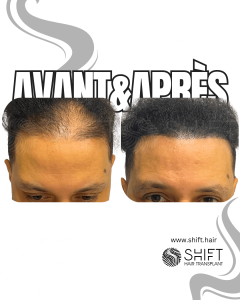 Avant Après de la micropigmentation du cuir chevelu pour le camouflage de densité en Turquie chez SHIFT Hair à Istanbul 35 3