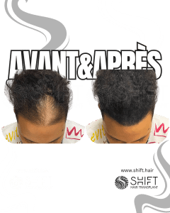 Avant Après de la micropigmentation du cuir chevelu pour le camouflage de densité en Turquie chez SHIFT Hair à Istanbul 36 3