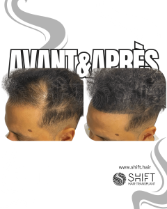 Avant Après de la micropigmentation du cuir chevelu pour le camouflage de densité en Turquie chez SHIFT Hair à Istanbul 38 3
