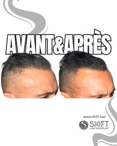 Avant Après de la micropigmentation du cuir chevelu pour le camouflage de densité en Turquie chez SHIFT Hair à Istanbul 42 3