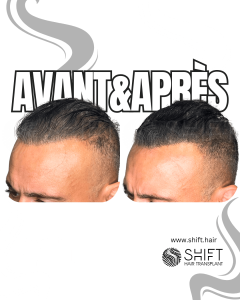 Avant Après de la micropigmentation du cuir chevelu pour le camouflage de densité en Turquie chez SHIFT Hair à Istanbul 43 3