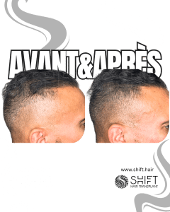Avant Après de la micropigmentation du cuir chevelu pour le camouflage de densité en Turquie chez SHIFT Hair à Istanbul 44 3