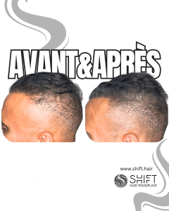 Avant Après de la micropigmentation du cuir chevelu pour le camouflage de densité en Turquie chez SHIFT Hair à Istanbul 45 3