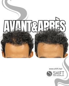 Avant Après de la micropigmentation du cuir chevelu pour le camouflage de densité en Turquie chez SHIFT Hair à Istanbul 46 3