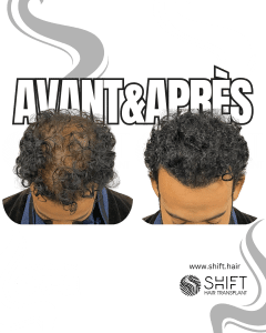 Avant Après de la micropigmentation du cuir chevelu pour le camouflage de densité en Turquie chez SHIFT Hair à Istanbul 47 3