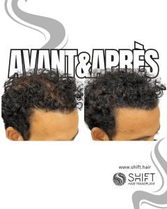 Avant Après de la micropigmentation du cuir chevelu pour le camouflage de densité en Turquie chez SHIFT Hair à Istanbul 48 3