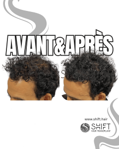 Avant Après de la micropigmentation du cuir chevelu pour le camouflage de densité en Turquie chez SHIFT Hair à Istanbul 49 3