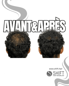 Avant Après de la micropigmentation du cuir chevelu pour le camouflage de densité en Turquie chez SHIFT Hair à Istanbul 51 3
