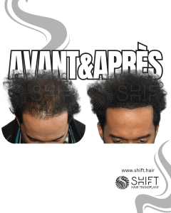 Avant Après de la micropigmentation du cuir chevelu pour le camouflage de densité en Turquie chez SHIFT Hair à Istanbul 52 3