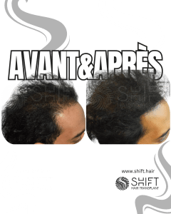 Avant Après de la micropigmentation du cuir chevelu pour le camouflage de densité en Turquie chez SHIFT Hair à Istanbul 53 3