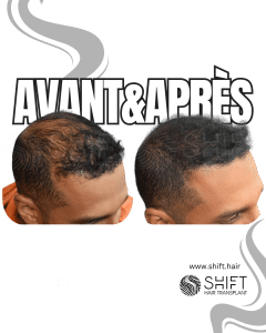 Avant Après de la micropigmentation du cuir chevelu pour le camouflage de densité en Turquie chez SHIFT Hair à Istanbul 55 3
