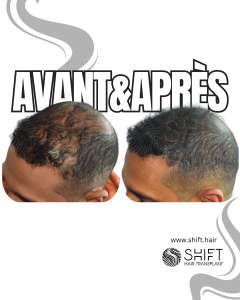 Avant Après de la micropigmentation du cuir chevelu pour le camouflage de densité en Turquie chez SHIFT Hair à Istanbul 56 3