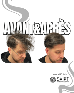 Avant Après de la micropigmentation du cuir chevelu pour le camouflage de densité en Turquie chez SHIFT Hair à Istanbul 58 3