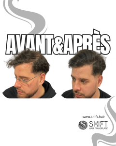 Avant Après de la micropigmentation du cuir chevelu pour le camouflage de densité en Turquie chez SHIFT Hair à Istanbul 59 3