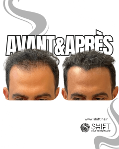 Avant Après de la micropigmentation du cuir chevelu pour le camouflage de densité en Turquie chez SHIFT Hair à Istanbul 60 3