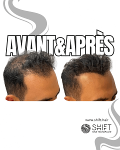 Avant Après de la micropigmentation du cuir chevelu pour le camouflage de densité en Turquie chez SHIFT Hair à Istanbul 61 3