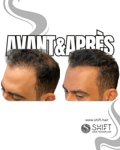 Avant Après de la micropigmentation du cuir chevelu pour le camouflage de densité en Turquie chez SHIFT Hair à Istanbul 62 3