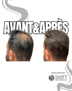 Avant Après de la micropigmentation du cuir chevelu pour le camouflage de densité en Turquie chez SHIFT Hair à Istanbul 63 3