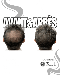 Avant Après de la micropigmentation du cuir chevelu pour le camouflage de densité en Turquie chez SHIFT Hair à Istanbul 64 3