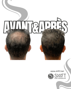 Avant Après de la micropigmentation du cuir chevelu pour le camouflage de densité en Turquie chez SHIFT Hair à Istanbul 65 3