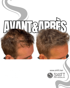 Avant Après de la micropigmentation du cuir chevelu pour le camouflage de densité en Turquie chez SHIFT Hair à Istanbul 67 3