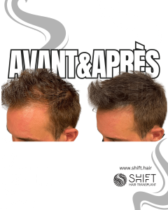 Avant Après de la micropigmentation du cuir chevelu pour le camouflage de densité en Turquie chez SHIFT Hair à Istanbul 68 3