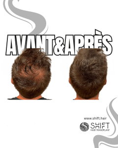 Avant Après de la micropigmentation du cuir chevelu pour le camouflage de densité en Turquie chez SHIFT Hair à Istanbul 69 3