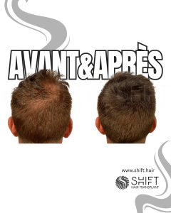 Avant Après de la micropigmentation du cuir chevelu pour le camouflage de densité en Turquie chez SHIFT Hair à Istanbul 70 3
