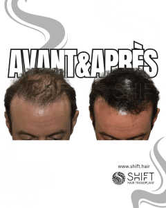 Avant Après de la micropigmentation du cuir chevelu pour le camouflage de densité en Turquie chez SHIFT Hair à Istanbul 71 3