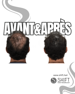 Avant Après de la micropigmentation du cuir chevelu pour le camouflage de densité en Turquie chez SHIFT Hair à Istanbul 73 3