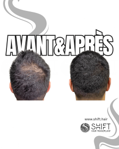 Avant Après de la micropigmentation du cuir chevelu pour le camouflage de densité en Turquie chez SHIFT Hair à Istanbul 74 3