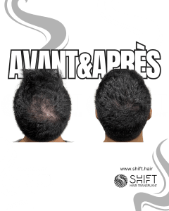 Avant Après de la micropigmentation du cuir chevelu pour le camouflage de densité en Turquie chez SHIFT Hair à Istanbul 75 3