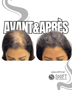 Avant Après de la micropigmentation du cuir chevelu pour les femmes pour le camouflage de densité en Turquie chez SHIFT Hair à Istanbul 01 3