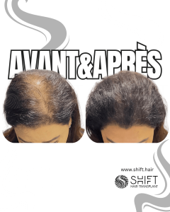 Avant Après de la micropigmentation du cuir chevelu pour les femmes pour le camouflage de densité en Turquie chez SHIFT Hair à Istanbul 02 3
