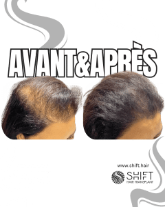 Avant Après de la micropigmentation du cuir chevelu pour les femmes pour le camouflage de densité en Turquie chez SHIFT Hair à Istanbul 03 3