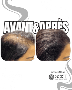 Avant Après de la micropigmentation du cuir chevelu pour les femmes pour le camouflage de densité en Turquie chez SHIFT Hair à Istanbul 05 3