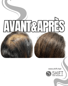 Avant Après de la micropigmentation du cuir chevelu pour les femmes pour le camouflage de densité en Turquie chez SHIFT Hair à Istanbul 06 3
