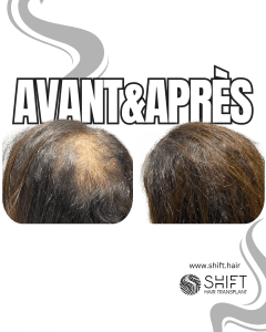 Avant Après de la micropigmentation du cuir chevelu pour les femmes pour le camouflage de densité en Turquie chez SHIFT Hair à Istanbul 07 3