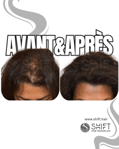 Avant Après de la micropigmentation du cuir chevelu pour les femmes pour le camouflage de densité en Turquie chez SHIFT Hair à Istanbul 09 3