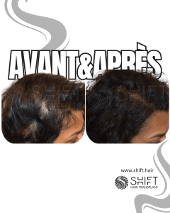 Avant Après de la micropigmentation du cuir chevelu pour les femmes pour le camouflage de densité en Turquie chez SHIFT Hair à Istanbul 10 3