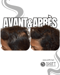 Avant Après de la micropigmentation du cuir chevelu pour les femmes pour le camouflage de densité en Turquie chez SHIFT Hair à Istanbul 11 3