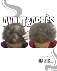 Avant Après de la micropigmentation du cuir chevelu pour les femmes pour le camouflage de densité en Turquie chez SHIFT Hair à Istanbul 13 3