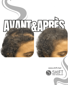 Avant Après de la micropigmentation du cuir chevelu pour les femmes pour le camouflage de densité en Turquie chez SHIFT Hair à Istanbul 14 3