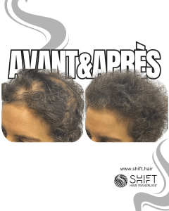 Avant Après de la micropigmentation du cuir chevelu pour les femmes pour le camouflage de densité en Turquie chez SHIFT Hair à Istanbul 15 3