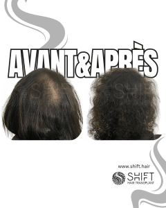 Avant Après de la micropigmentation du cuir chevelu pour les femmes pour le camouflage de densité en Turquie chez SHIFT Hair à Istanbul 18 3
