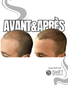 Avant Après de la micropigmentation du cuir chevelu pour un look rasé en Turquie chez SHIFT Hair à Istanbul 01 3